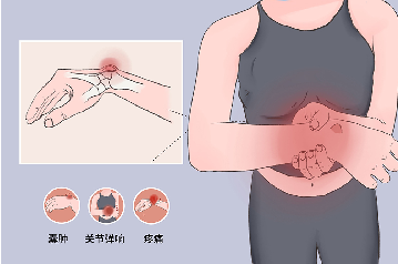 【健康科普系列二十】腕背腱鞘囊腫小知識(shí)